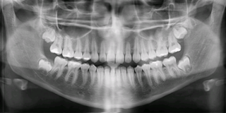 impacted wisdom teeth panoramic